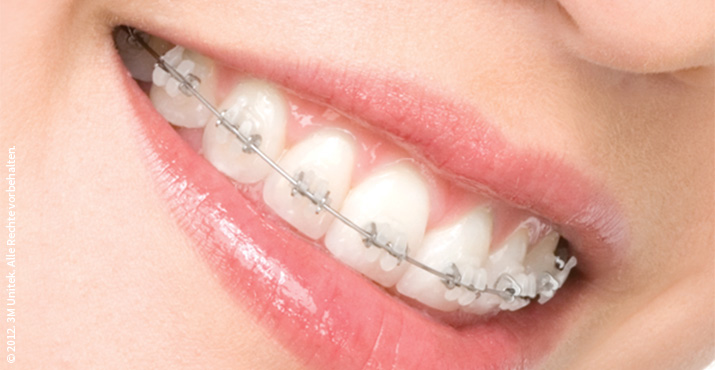 Therapie von Zahnfehlstellungen